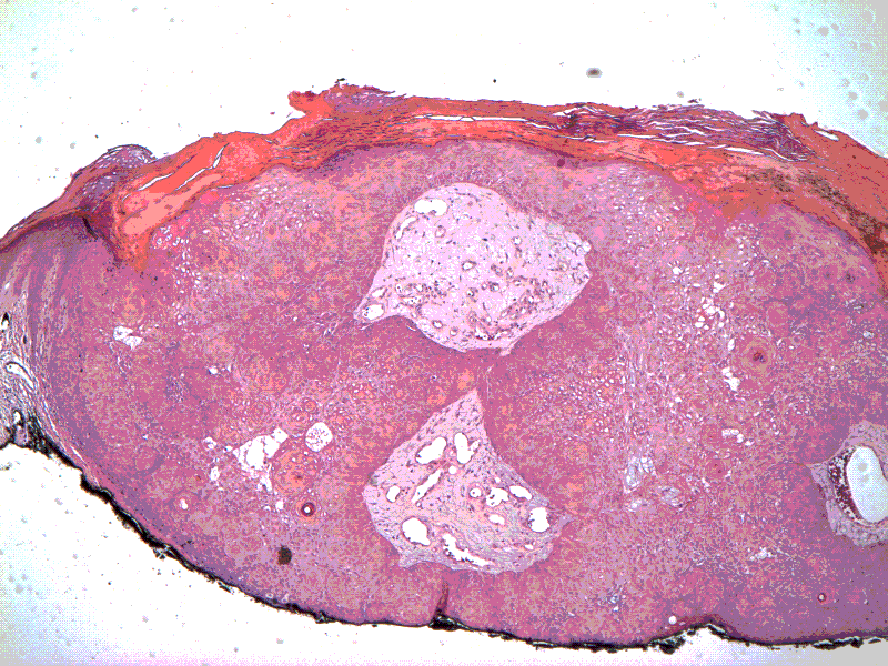 Figure 5: Aggregates of anomalous keratinocytes with lack of epithelial dysplasia in inverted follicular keratosis [14].