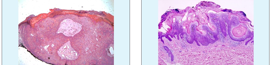 Figure 7: Clusters of dyskeratotic keratinocytes with superimposed hyperkeratotic and acanthotic epithelium in inverted follicular dyskeratosis [16].
