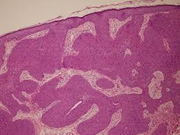 Figure 9: Basaloid accumulations with follicular architecture and minimal perifollicular inflammation in inverted follicular keratosis [16].