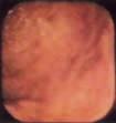 Figure 1: Multiple erythematous spots seen in the antrum.