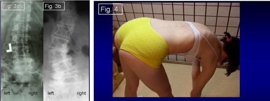 Figure 2: Patient 60 years old. Hyperlordosis of lumbar spine. Almost horizontal position of sacral bone (arrow). Degenerative changes in spine. Patient with chronic pain because of pressure on nerves roots.