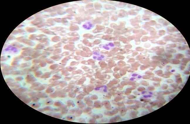 Figure 1: Leukemoid reaction (Peripheral blood smear, Leishman stain, 400x).