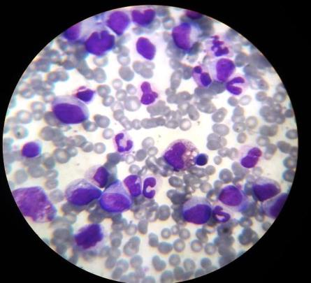Figure 2: CML (Peripheral blood smear, Leishman stain, 400x).