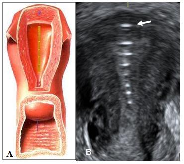 Figure 1: A) Frameless IUD attached to the fundus of the uterus. B) Coronal ultrasound of the IUD in situ at follow-up. The arrow shows the anchor marker which is highly visible and demonstrates proper anchoring. Frameless IUDs or IUS have many advantages as they fit in cavities of every size and shape and will adapt to the uterine cavities during involution of the postpartum uterus due to their small and flexible design (Figure 2a and Figure 2b).