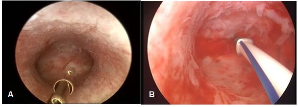 Figure 2: A) Hysteroscopic view of the frameless copper IUD. B) Hysteroscopic view of the frameless LNG-IUS. Note the compatibility of the devices with the uterine cavity. Anchoring of frameless design IUDs, which lack conventional cross arms, to the fundal wall of the uterus has been medically and commercially available throughout Europe for many years in the form of GyneFix® (Control Research, Belgium). Multiple clinical trials demonstrated the anchoring technique to bea valid concept [12]. Upon insertion of the device, the copper ions are released from the outside as well as from the inside of the copper cylinders, generating high copper ion release. The copper ions will spread throughout the genital tract and fallopian tubes, preventing fertilization and ectopic pregnancy. The 10-year frameless IUD was found to be as effective as tubal sterilization [12]. Due to its long duration of action it could be positioned as a reversible alternative to tubal sterilization which is particularly interesting in postpartum women.