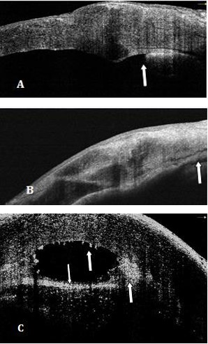 Figure 3: Angle opening distance (AOD), angle recess area (ARA), trabecular iris space area (TISA).