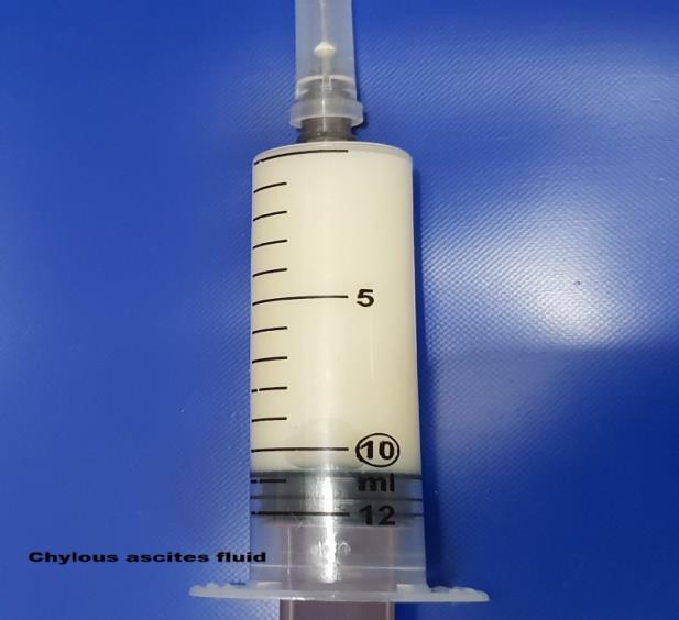Figure 2: Showing Milky white ascitic fluid.