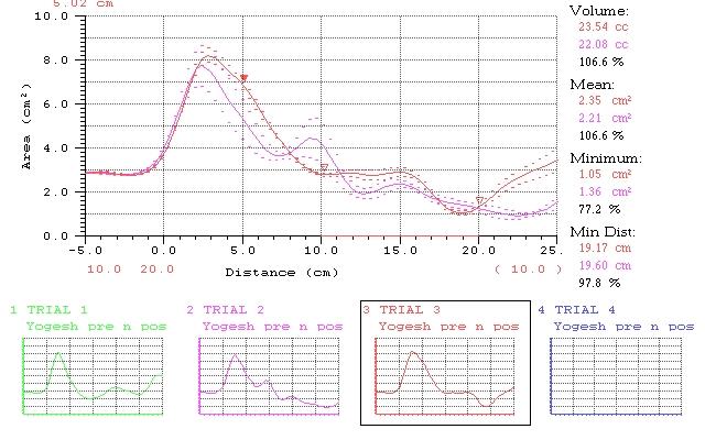 Figure 2: Acoustic Pharyngometry report.