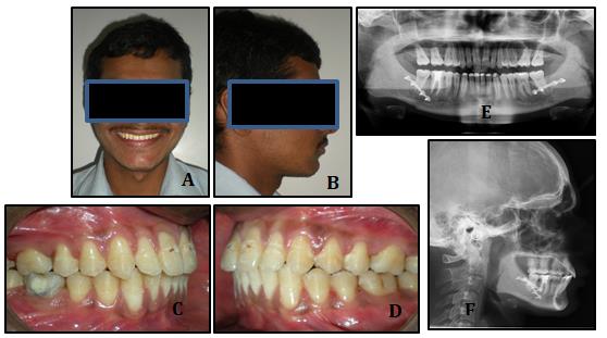 Figure 6: Acoustic Pharyngometry report.
