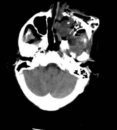Figure 1: CT Scan of paranasal sinuses revealed a bony mass arising from medial wall of the left maxillary antrum extending to the alveolar margin.