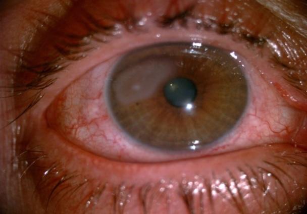 Figure 2: Systemic exanination were revealed a few discoid erythematos lesions in patient’s noise, ear and face.