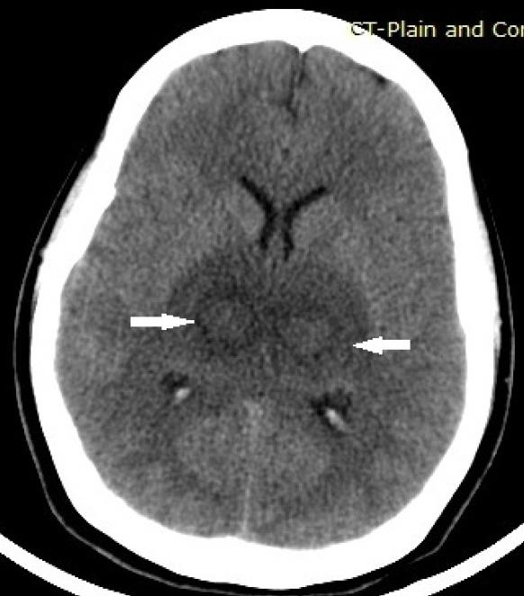 Figure 1: Plain computed tomography brain showing symmetrical hypodensity in the thalami which appeared swollen and centrally located hyperdense area within the hypodensity on both sides resembling “owl’s eye appearance”.