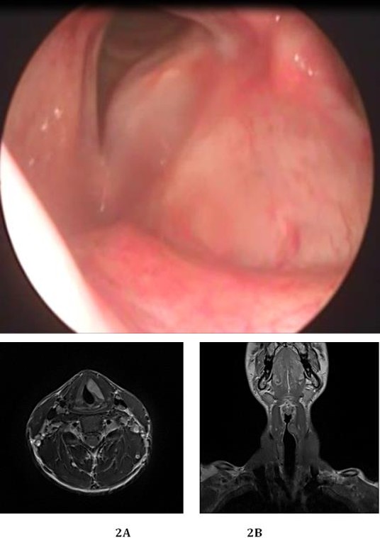 Figure 1: Laryngeal lesion occupying the left true vocal cord.
