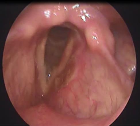 Figure 3: Intraoperative- resection of the laryngeal fibroma.