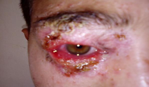 Figure 1: Erythema and melicericcrusts of the periorbital region, + ectropian.