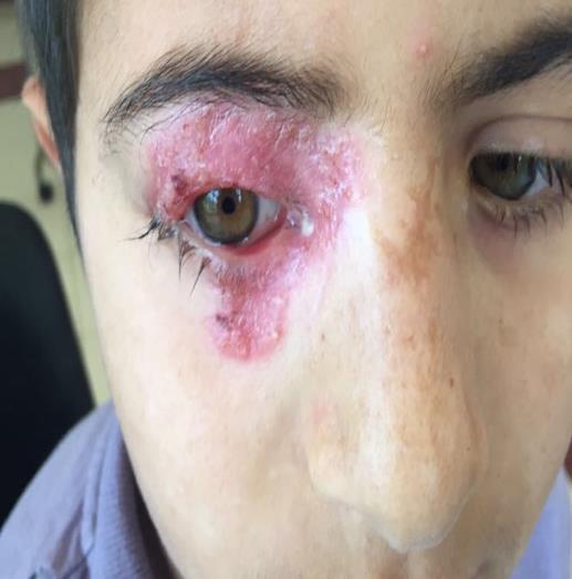 Figure 2: After treatment of super infection, persistence of erythema, dander and eyelash depilation.