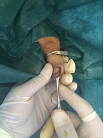 Figure 2: Avulsion of the nail.