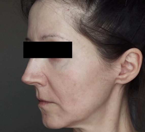 Figure 2: After isotretinoin treatment, left face.