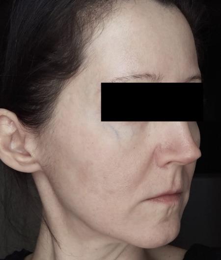 Figure 4: After isotretinoin treatment, right face.