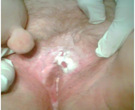 Figure 1: Patient K, 76 years old. D-z: Cancer of the vulva (Т1NоМо) in the area of the clitoris on the background of sclerotic lichen. Soft fibroma of the skin of the inner thigh.