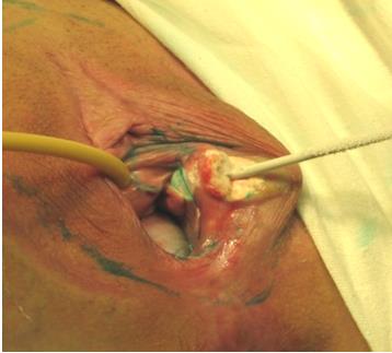 Figure 3: Кriоdеwitаlizаtia of tumour.
