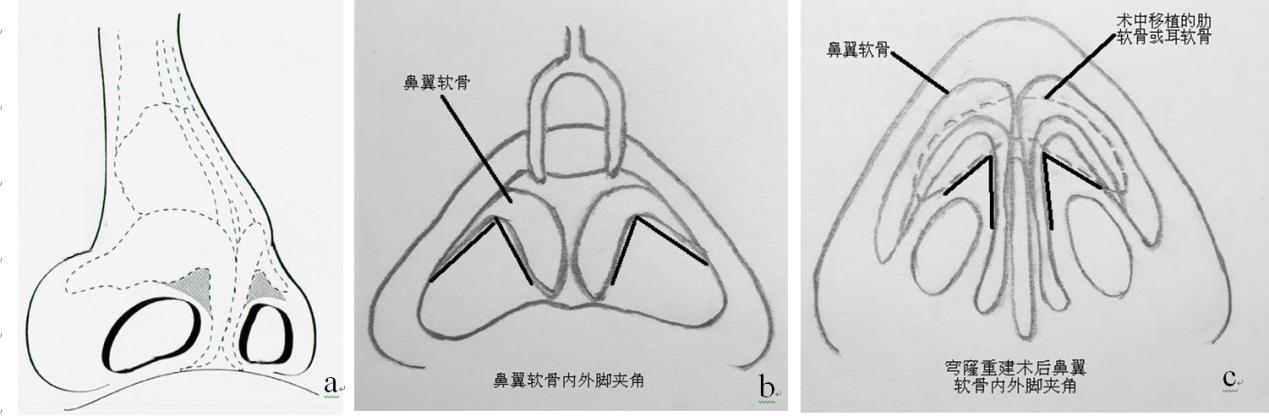 Figure 1: a: The shaded area of the schematic diagram is the soft-tissue triangle of the nose.