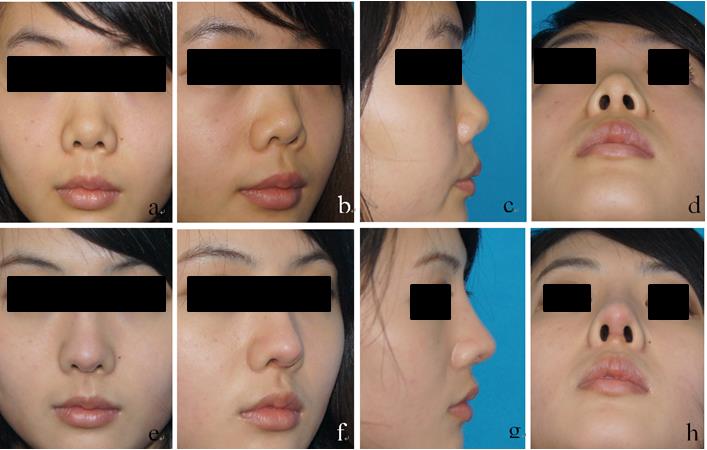 Figure 3: Typical case 1:female, 21 years old,with soft-tissue triangle deformities combined with flat nose and short nose, the 7th costal cartilage was taken intraoperatively , soft-tissue triangle deformities correction+shot nose deformity correction+e-PTFE augmentation rhinoplasty were carried out. (a, b, c, d for preoperative situation; e, f, g, h shows half a year after operative).