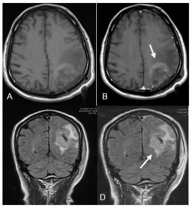 Figure 1: EPMRI (within 48 hours post op) A: Axial T1 – weighted B: Axial T1-post contrast C: Coronal T2 weighted D: Coronal T2 post contrast Status post grade IV glioblastoma resection Abnormal signals along the inferior aspect as well as along the periphery of resection cavity with mild enhancement suggestive of residual disease.