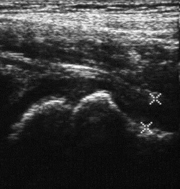 Figure 2: Radiograph of pelvis with B/L hips in AP view showing widening of joint space of left hip.