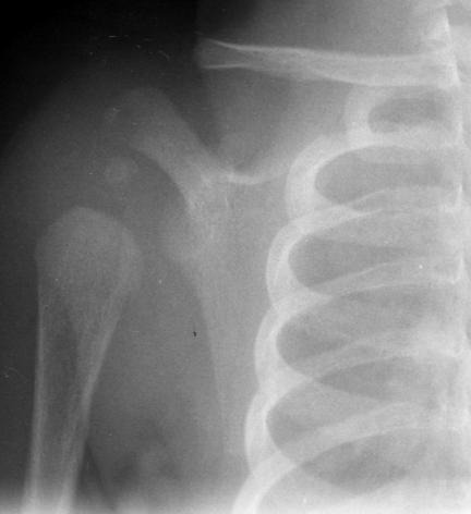 Figure 4: Radiograph of left knee lateral view showing soft tissue swelling around left knee with changes noted over left distal femur.