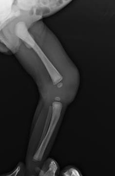 Figure 5: Radiograph of right shoulder AP view showing increased joint space over right shoulder joint.