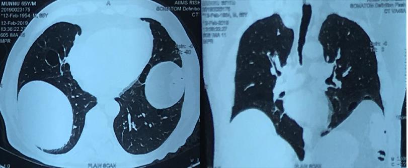 Figure 1: CECT of thorax showing multiple pulmonary sub-pleural bullae.