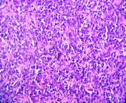 Figure 2: Mixture of neoplastic epithelial cells and lymphocytes (Hematoxylin and Eosin stain 10x view).
