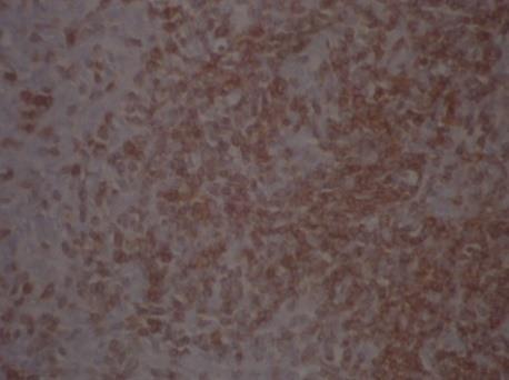 Figure 4: CD 57 - Positive for mature lymphocytes (1).