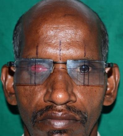Figure 1: Vertical and Horizontal extensions marked on the face with the use of eyewear markings.
