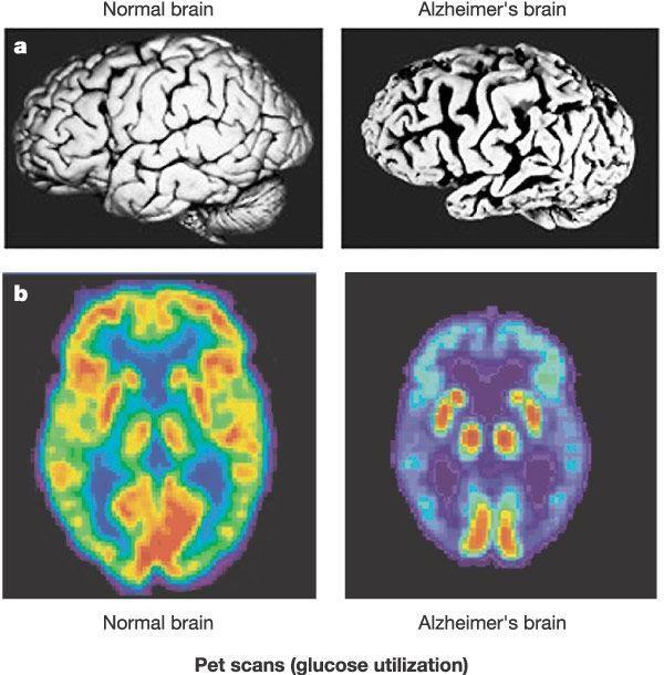 Figure 3: Morphology & Anatomy (top) and Pet scans of a Normal- verus an Alzheimer Brain.
