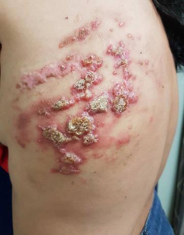Figure 1: Lymphangioma circumscriptum. Multiple localized, well- circumscribed clusters of plaques and vesicles filled with clear fluid, topped with yellowish red crusts, some eroded, with surrounding erythema, located on the left side of back.