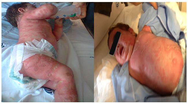 Figure 1: Facial edema and irritability.