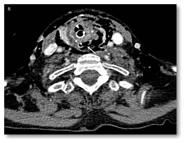 Figure 1: Contrast-enhanced CT scan showing a wide emphysema (asterisks) due to iatrogenic esophageal perforation (arrow). The patient underwent earlier orotracheal intubation (arrowhead) and nasogastic tube insertion (dotted arrow). Exam performed seven hours after injury.