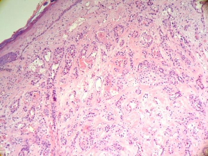 Figure 1: (a) Neoformation in the left parietal-temporal and left retroarticular region.