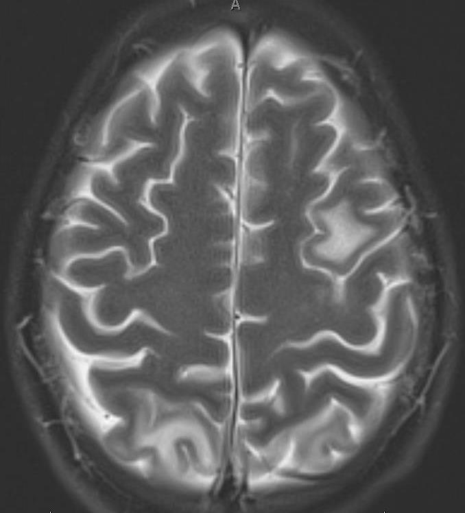 Figure 1: MRI Brain.
