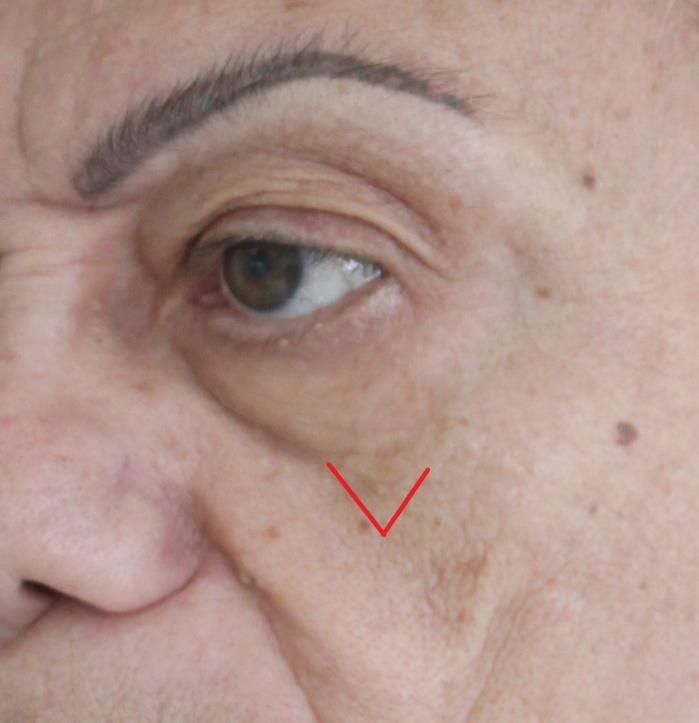 Figure 11: Nasolabial groove, formed by the transition of malar excess skin (left) with nasolabial adipose compartment to the labial skin, with scarce subcutaneous and firmly adhered to the orbicularis oris muscle (right), besides the insertions of the superior lip elevator muscles.