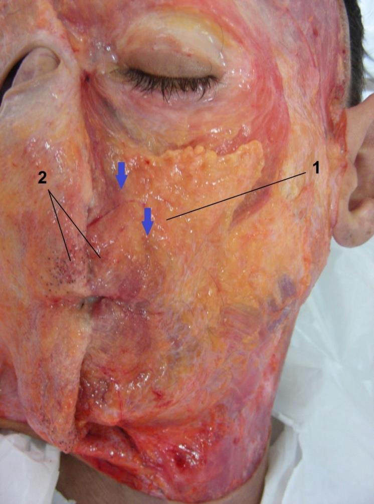 Figure 12: Nasolabial groove (blue arrows). Nasolabial subcutaneous adipose compartment (1), and dissected skin over the orbicularis oris muscle evidencing scarce subcutaneous tissue.
