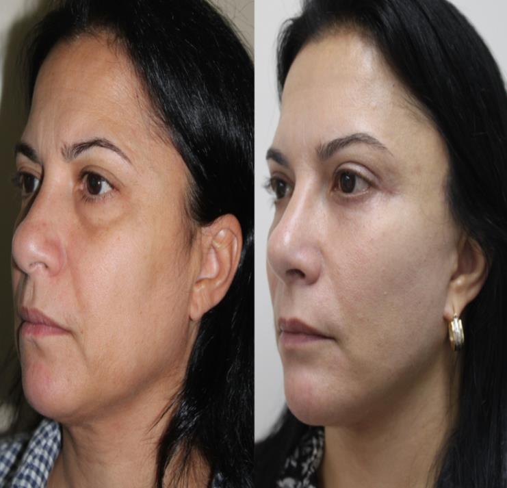 Figure 15: Preoperative (left) and one year postoperative (right) a facelift with SMAS plication, frontotemporal elevation, blepharoplasty, and facial lipoplasty.