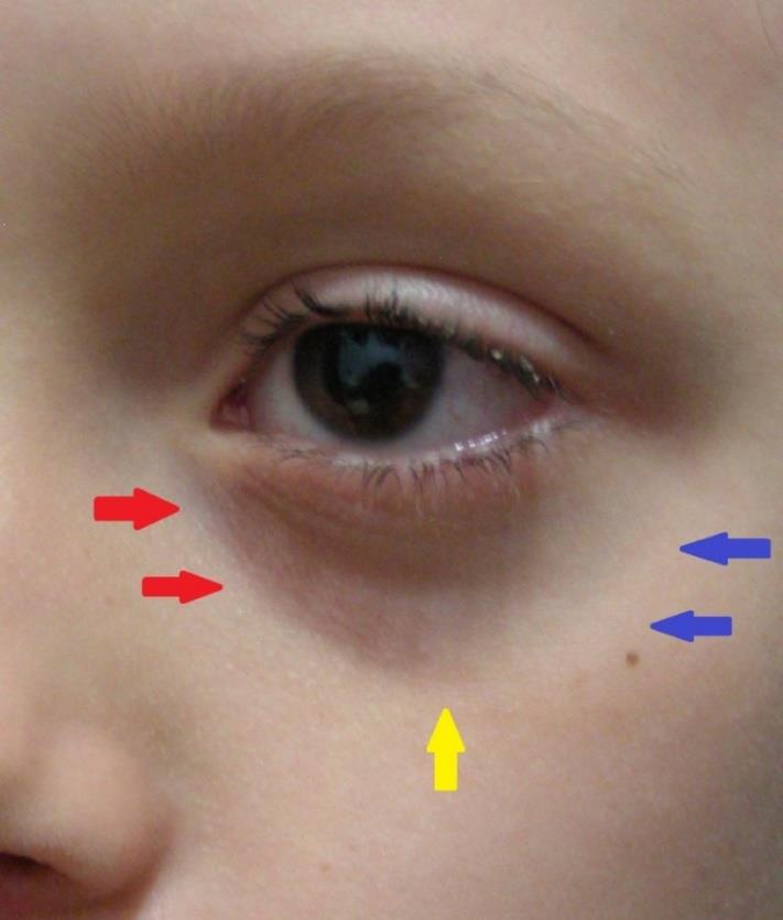 Figure 3: Unaesthetic facial characteristics. (1) nasolacrimal sulcus, (2) palpebromalar groove, (3) buccal zygomatic groove, (Star) V-shaped deformity, (4) nasolabial groove, (5) labiomental groove, (6) nasolabial fat compartment, (7) jowl.
