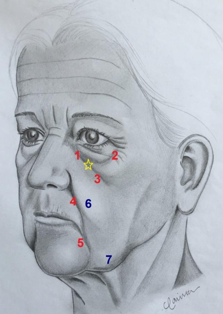 Figure 4: 6-year-old child with nasolacrimal sulcus (red arrows), palpebromalar groove (blue arrows) and V- shaped deformity (yellow arrow). It is located below the medial canthus of the eye and is directed inferiorly and laterally to a little more than the lateral half of the orbit, a few millimeters below the orbital rim. It is mostly caused by the transition from the thin palpebral skin, devoid of subcutaneous adipose tissue, to the thicker malar skin with underlying subcutaneous tissue [1,18]. A ligament has been described as its cause; however, other authors argue that the ligament is the bone origin of the pre-orbital part of the orbicularis oculi muscle (Figure 5) [19,20]. It may also be accentuated by a bone depression at the muscle origin, anterior to the anterior lacrimal crest [1,2]. In addition to depth variations, the thin skin is further darkened by abundant blood vessels and increased skin pigment (Figure 6) [1].