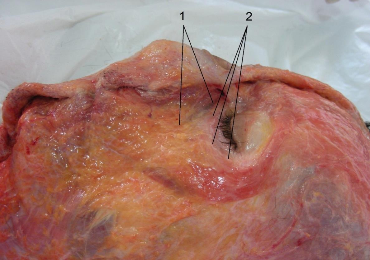 Figure 5: Anatomical dissection in fresh cadaver. (1) Nasolacrimal sulcus or tear trough. (2) Orbital bone rim. Note the presence of adipose compartments below the bone rim.