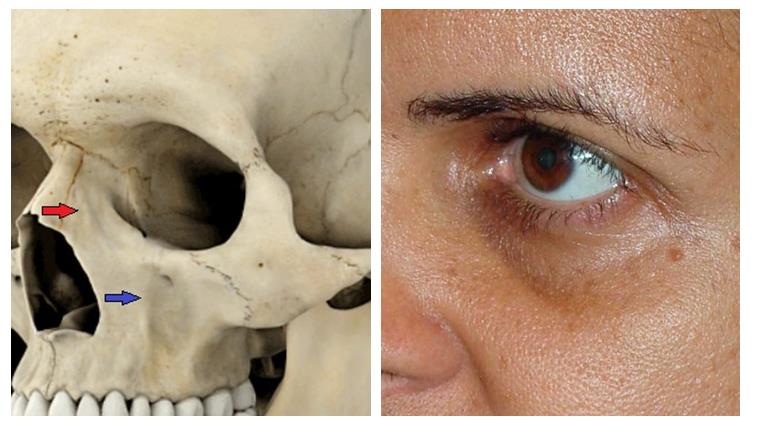Figure 6: Left: Bone depression in the origin of the orbicularis oculi muscle, pre-orbital segment (red arrow); Concavity of the maxillary bone (anterior border of the oral cavity) (blue arrow). Right: besides depth variations, the skin is thin and hyperpigmented.