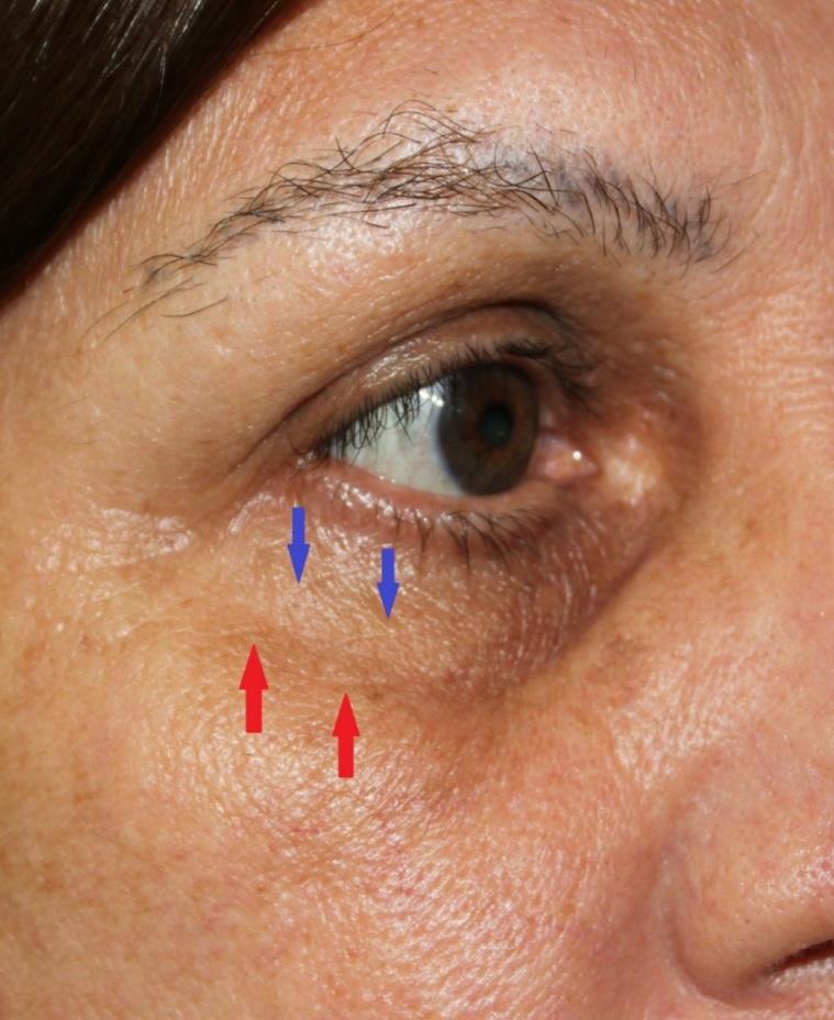 Figure 8: Left: buccal zygomatic groove (red arrow), accentuated by edema. Right: dissection in a fresh cadaver, demonstrating the buccal zygomatic groove showing the limits of the oral cavity and the malar region (blue arrows).