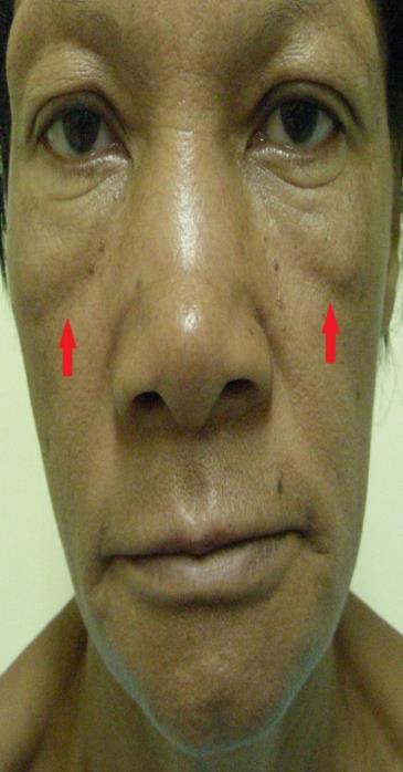 Figure 9: Observe the limits of the oral cavity demarcated by the zygomatic-buccal groove.